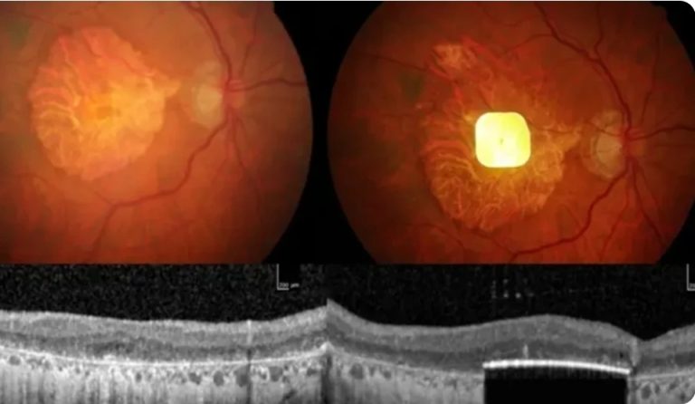 Shkencëtarët zhvillojnë implantin e syrit që u rikthen shikimin të verbërve