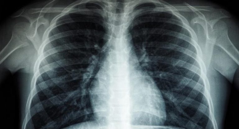 OBSH: Tuberkulozi është sëmundja infektive më vdekjeprurëse në botë, vret 1 milion njerëz çdo vit